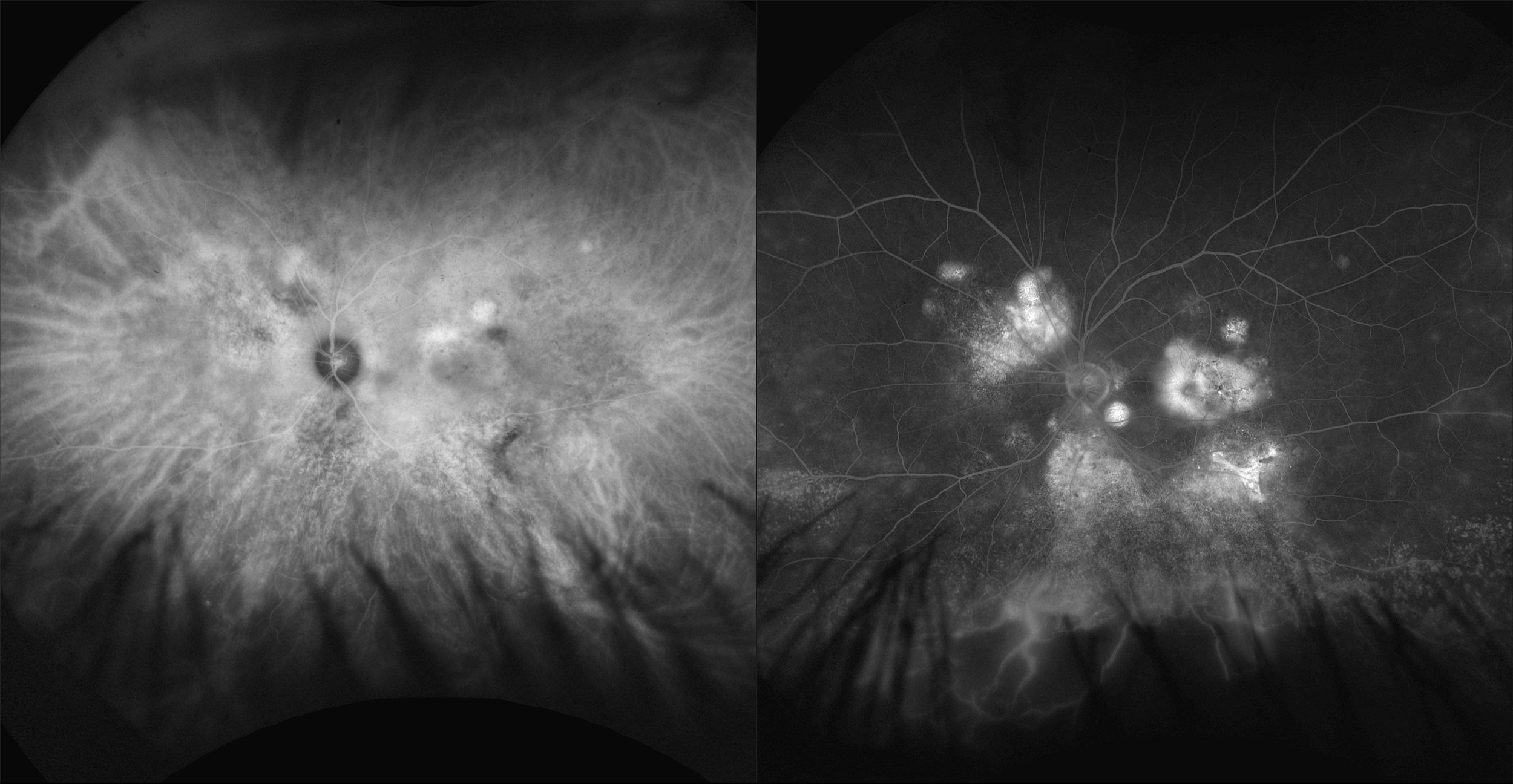 California - Central Serous Chorioretinopathy with Possible Vasculitis, AF, FA