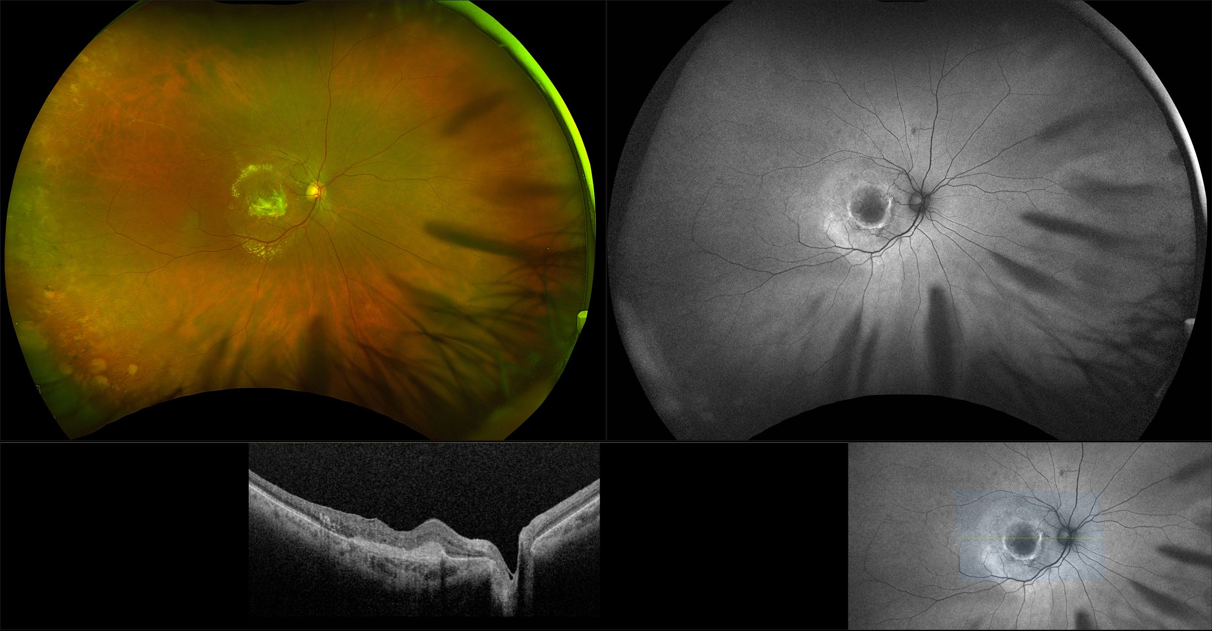 Silverstone - Branch Retinal Vein Occlusion with Disciform Scar, RG, FA, OCT