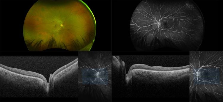 Silverstone - Coat's Disease with Post Op Posterior Vitreous Detachment, RG, AF, FA, OCT