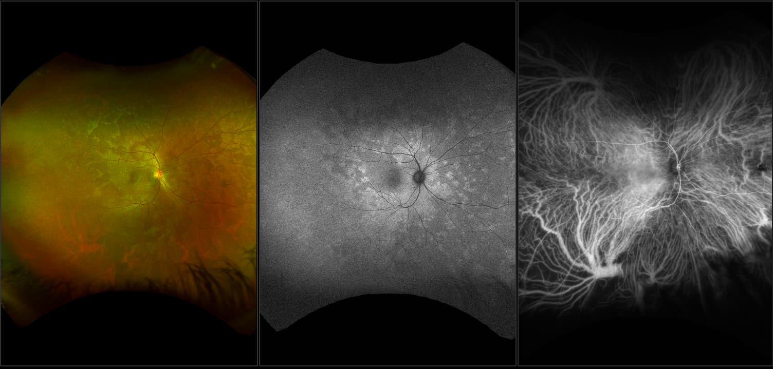 California - Acute Zonal Occult Outer Retinopathy (AZOOR), RG, AF, ICG