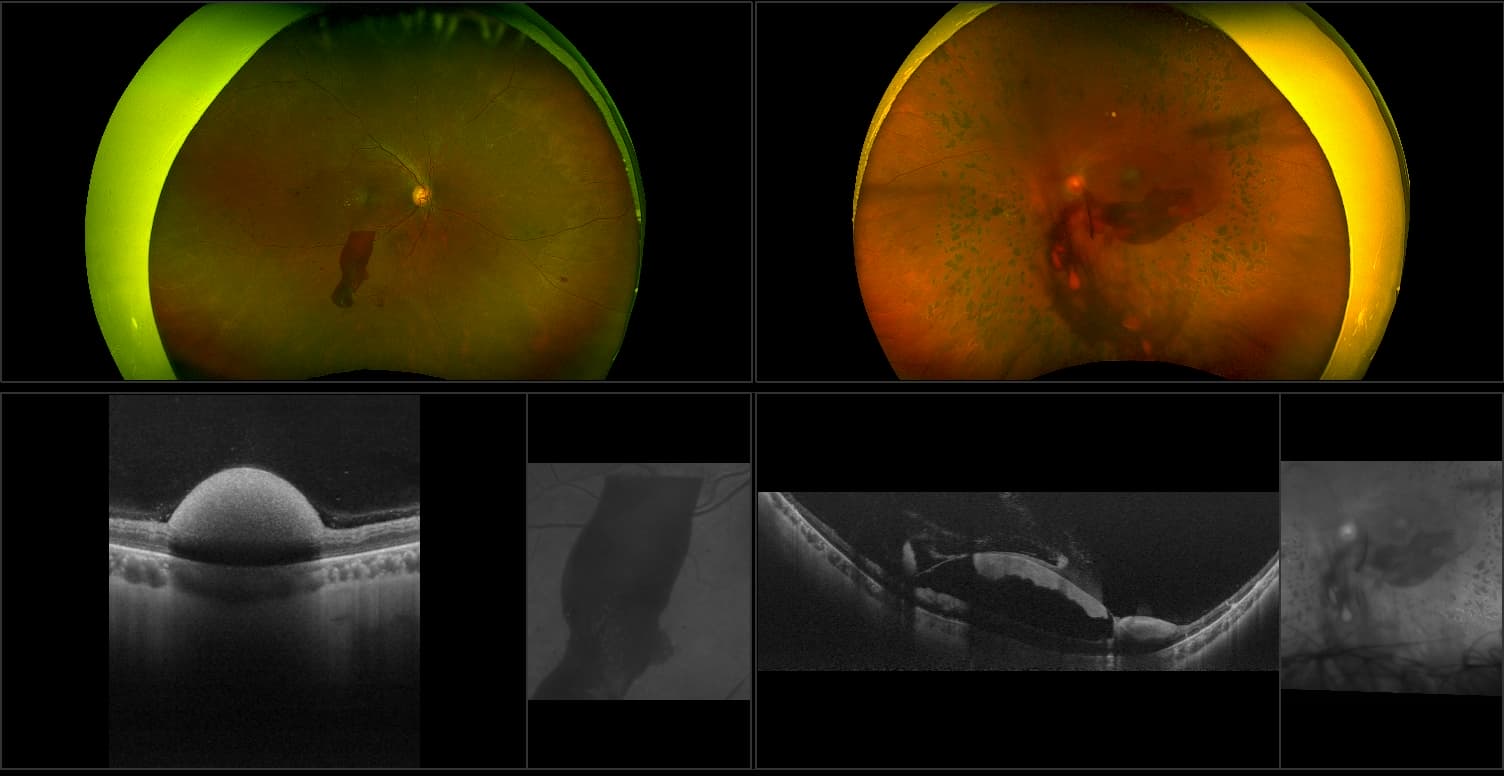 Silverstone - Diabetic Macular Edema with Active PDR, RG, AF, OCT
