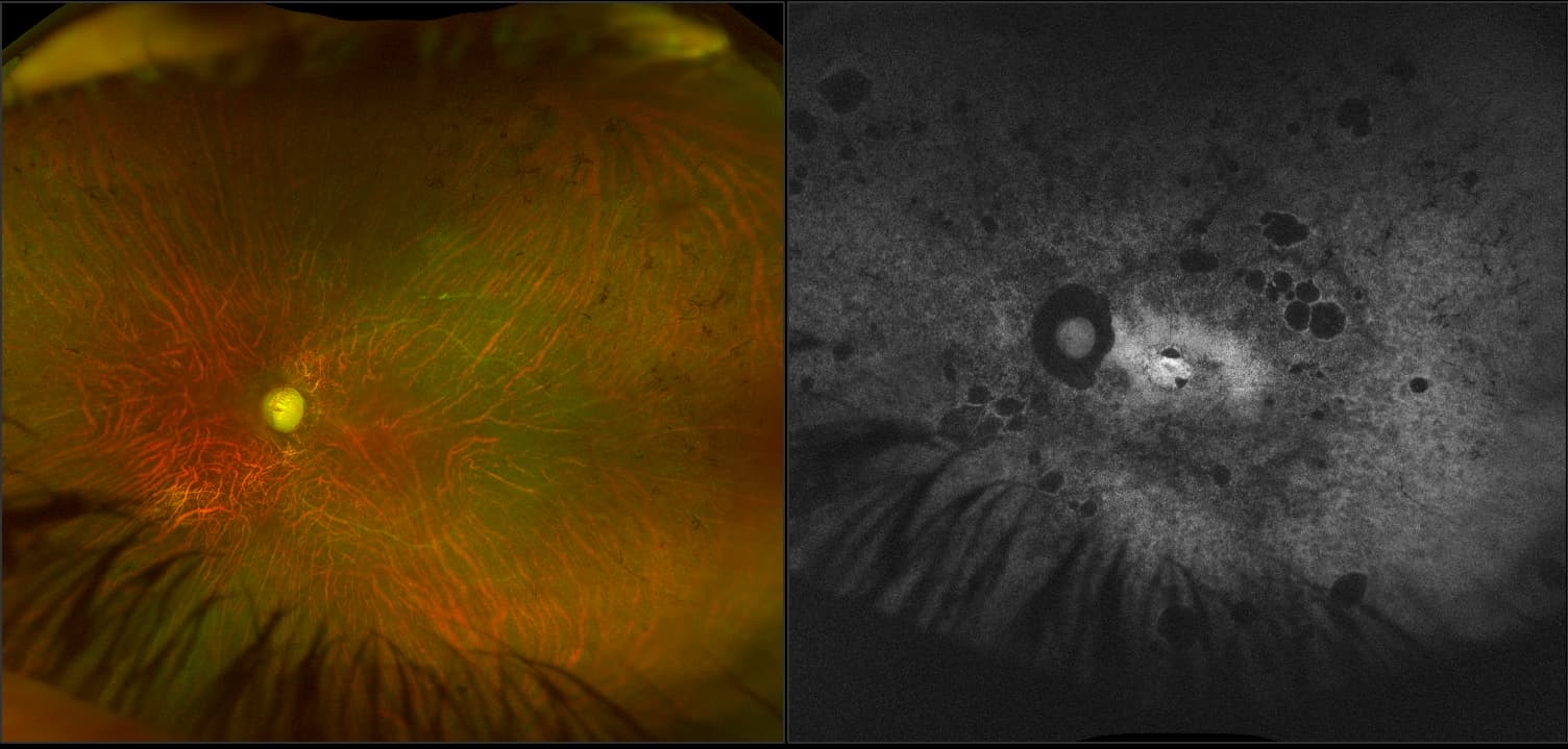 California - Uveitic Glaucoma - Stereo - RG, AF