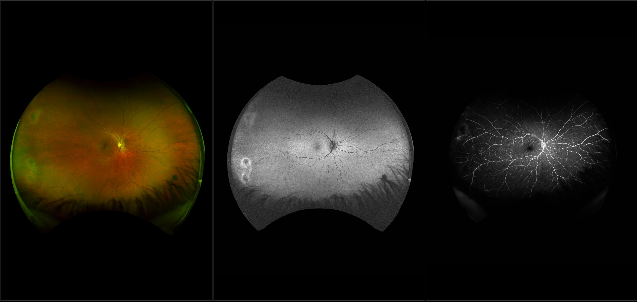 California - Retinal Hole with Horseshoe Tear, RG, AF, FA